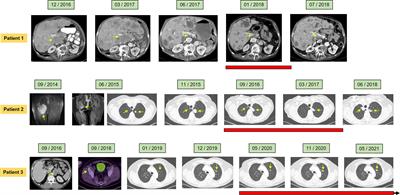 Gemcitabine Maintenance Therapy in Patients With Metastasized Soft Tissue Sarcomas